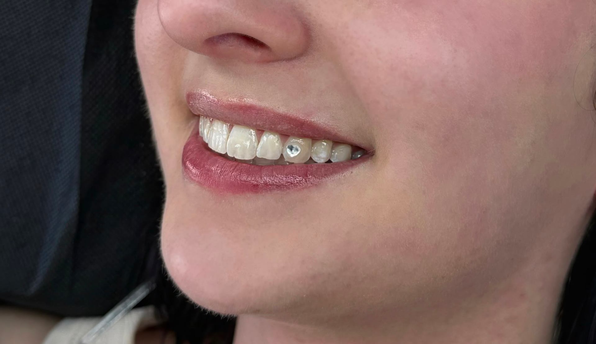 Tooth Gems Beispiel